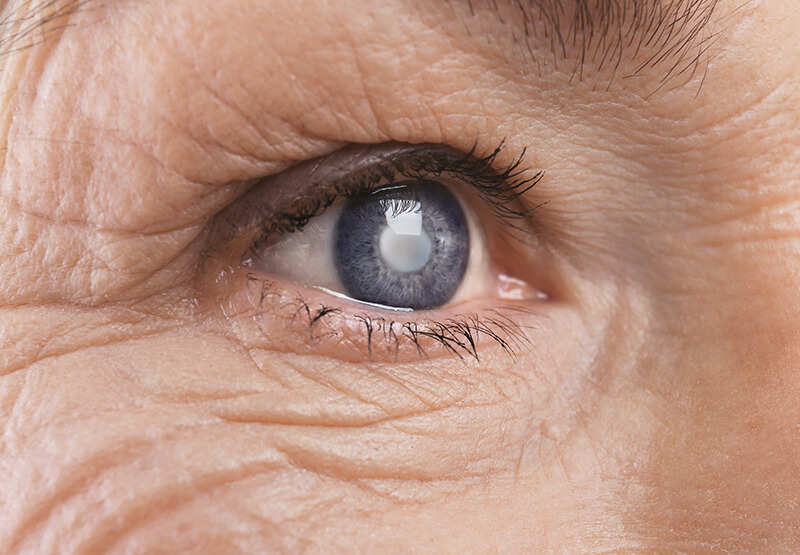 Closeup of a Cataract
