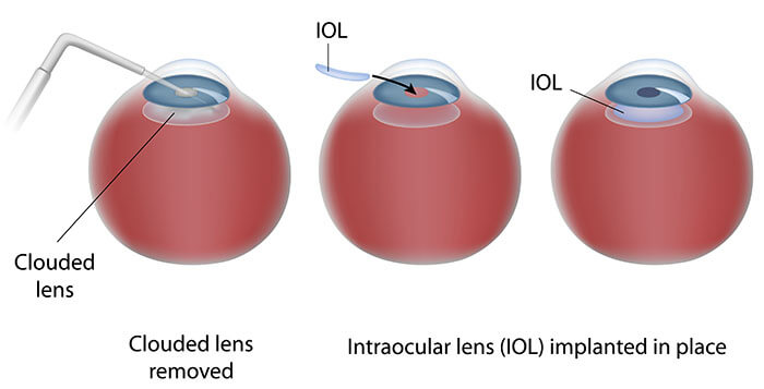 Chart Illustrating the Cataract Surgery Process