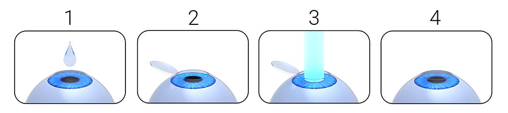 Chart Illustrating the LASIK Surgery Process